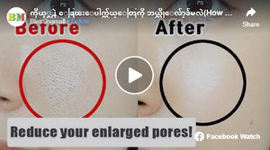 ကိုယ့်ရဲ့ ချွေးပေါက်ကျယ်တွေကို ဘယ်လိုလျော့ချမလဲ(How to reduce your enlarged pores)!